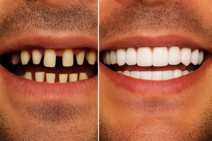 What Happened To Ziwe Teeth? Before And After Photos