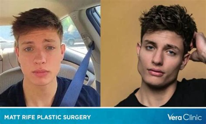 What Is Wrong With Matt Rife Health? Plastic Surgery & Weight Loss